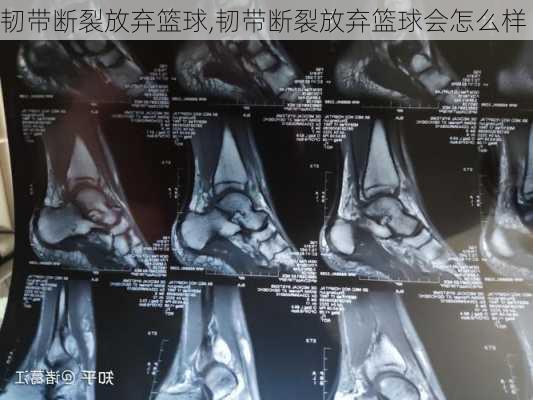 韧带断裂放弃篮球,韧带断裂放弃篮球会怎么样